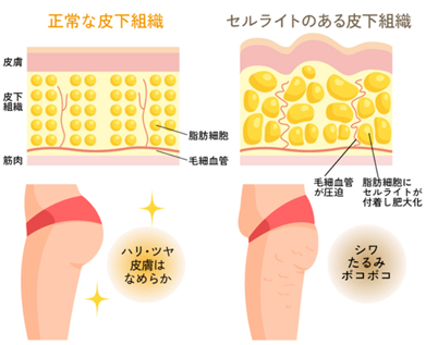 セルライトはこうしてできる